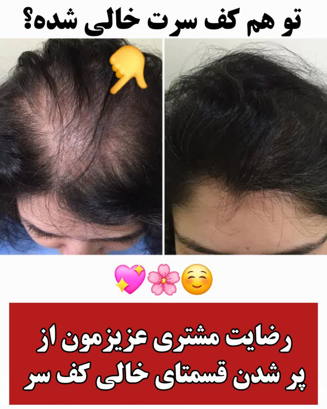 تونیک ضد ریزش و و رویش مجدد مو دوقلو برند اکسونیک-سوئیس خرید اقساطی