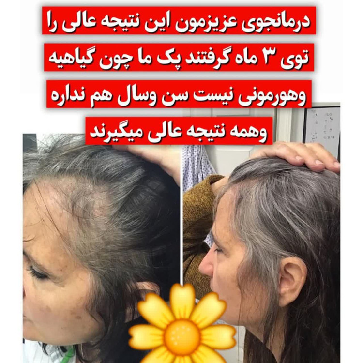 تونیک ضد ریزش و و رویش مجدد مو دوقلو برند اکسونیک-سوئیس خرید اقساطی